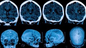 Estudian el uso de ultrasonido en pacientes con alzhéimer