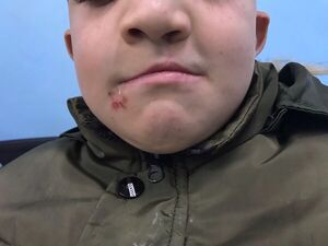 Paladar hendido y labio leporino en el Hospital Pediatrico