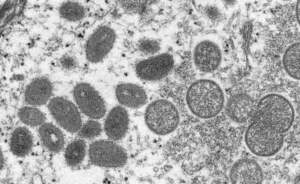 Instan a consultar ante cualquier síntoma de la viruela del mono - ADN Digital