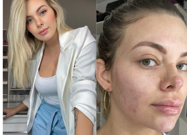 Cuerona se muestra sin maquillaje: “No soy perfecta, tengo acné y secuelas”