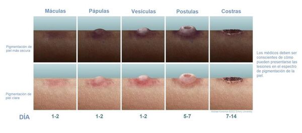 Faltan orientaciones clínicas actualizadas para la viruela del mono - Ciencia - ABC Color