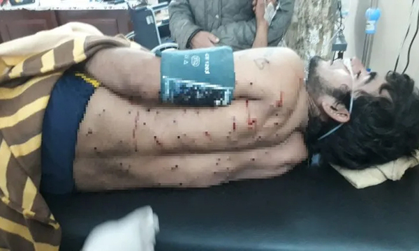 La espalda de un joven quedo como ‘‘colador’’ luego de recibir un disparo de arma de fuego - OviedoPress