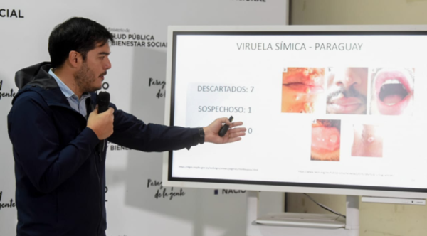 Sequera señaló "es muy raro aún que no reportemos casos de viruela del mono"