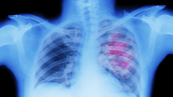 Diario HOY | Casi la mitad de las muertes por cáncer se atribuyen a factores de riesgo evitables