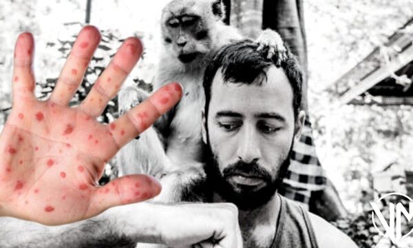 Viruela del mono: Cuba confirma su primer caso y paciente se encuentra en estado crítico