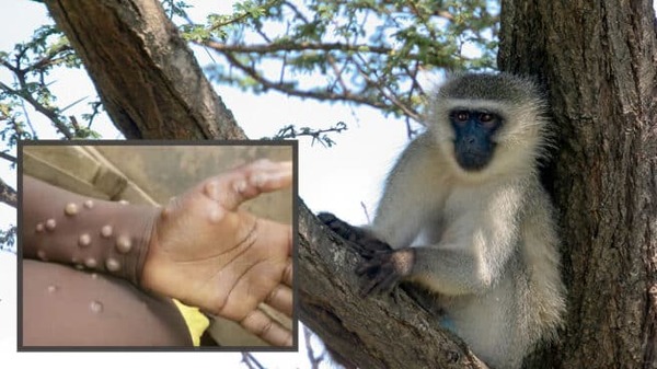 Paciente rapai con viruela del mono recorrió fronteras con Paraguay y en Pedro Juan emiten alerta