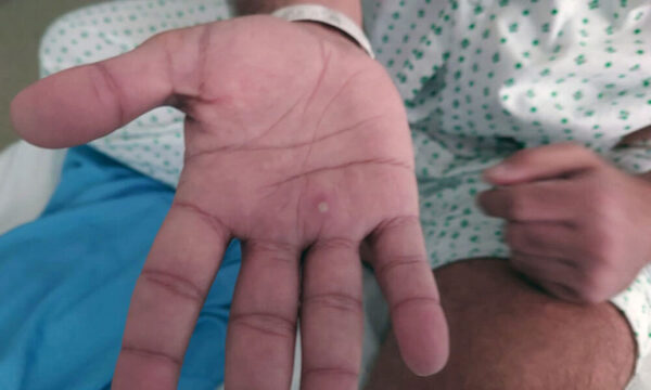 Dan de alta al primer paciente recuperado de viruela del mono en Bolivia