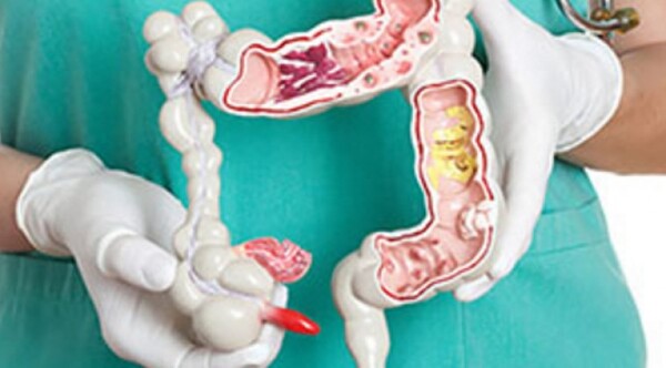 Diario HOY | Cáncer de colon, uno de los más frecuentes, es prevenible con detección precoz