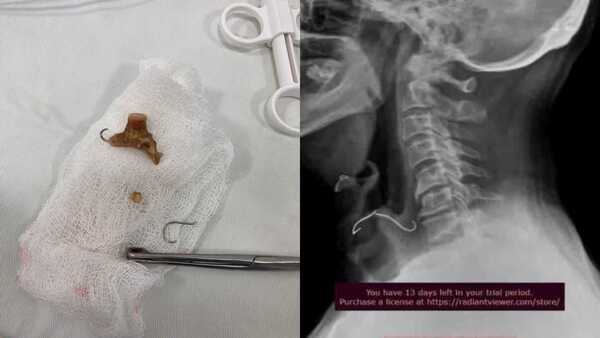 Traga su paladar y lo extraen con éxito en el Hospital Regional de Encarnación