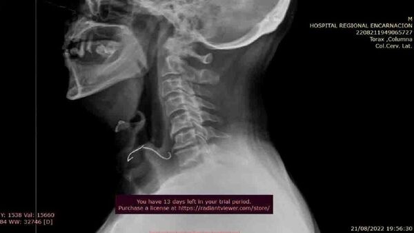 Un hombre tragó una parte de su paladar mientras dormía