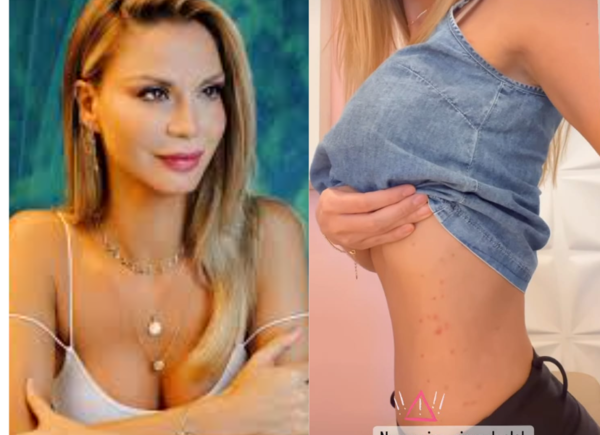 Dijeron que Egny Eckert tiene viruela del mono y ella aclaró: “Fue una alergia”