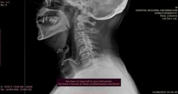 Tragó su paladar y se lo sacaron en el hospital - Nacionales - ABC Color