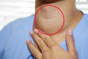 Procedimiento ayuda a descartar precozmente el cáncer de tiroides » San Lorenzo PY