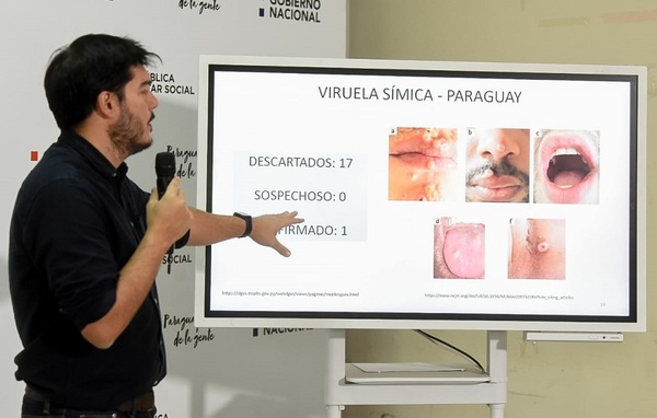 Diario HOY | Viruela del mono: cuántos días de aislamiento se recomiendan a pacientes afectados