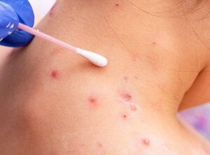 Epidemióloga emite recomendaciones ante sospechas de viruela del mono - Radio Imperio