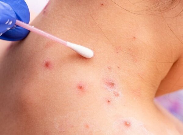 Epidemióloga emite recomendaciones ante sospechas de viruela del mono - Radio Imperio