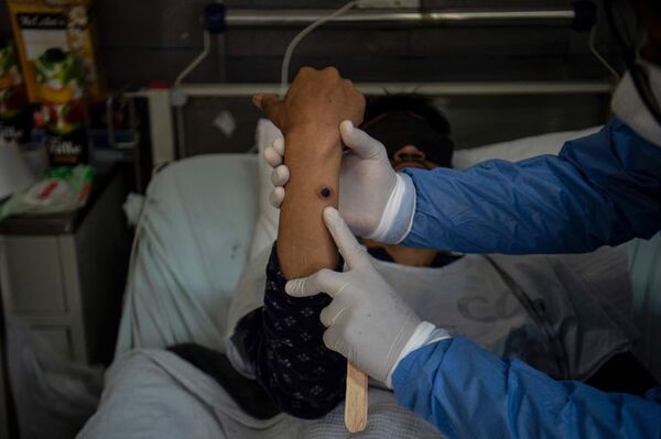 Viruela del mono: emiten recomendaciones para el manejo en hospitales - Nacionales - ABC Color