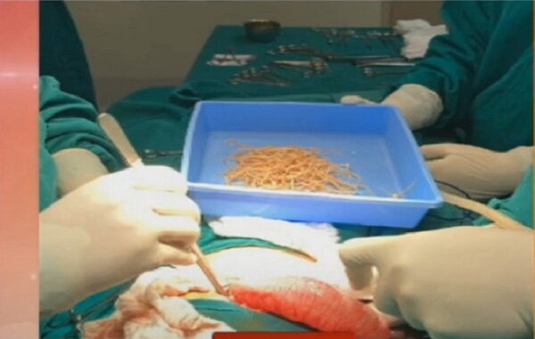 Operan a niño para extraerle un parasito de 40 cm - Paraguaype.com