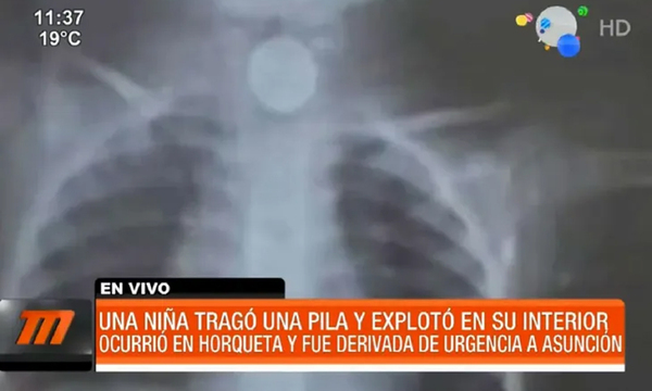 Una niña tragó una pila y el objeto explotó dentro de su cuerpo ocurrió en Concepción - OviedoPress