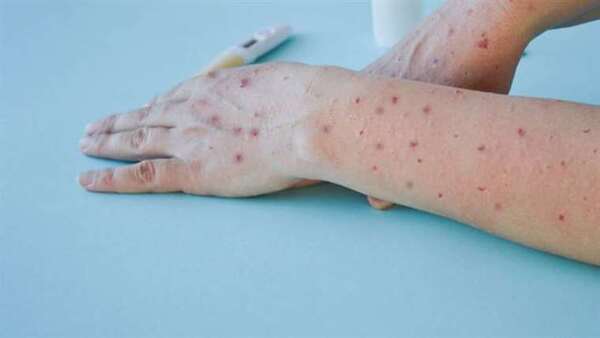 Diario HOY | Viruela del mono: identificaron en Reino Unido una nueva variante genética del virus