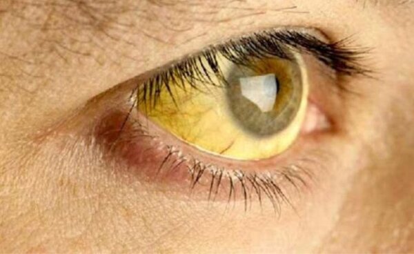 OPS activa alerta epidemiológica por fiebre amarilla
