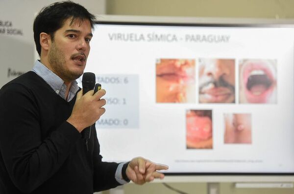Viruela del mono: paciente debe usar el tapabocas solamente cuando interactuará con otra persona, afirman - A La Gran 7-30 - ABC Color