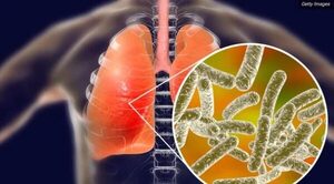Diario HOY | Legionella: investigación de brote en Argentina sigue en curso