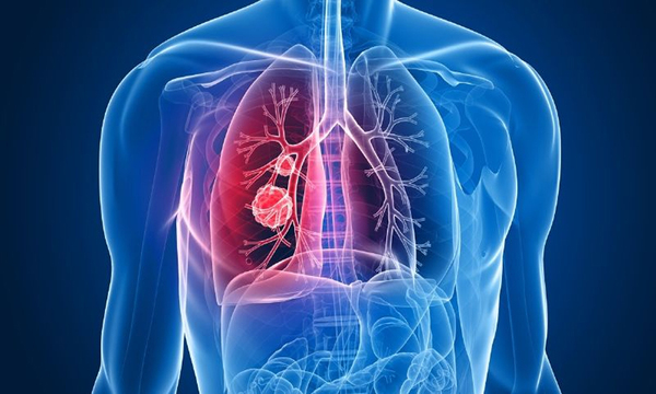 Así es la vida de una persona con fibrosis quística - OviedoPress