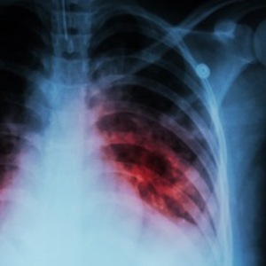 Tuberculosis afecta principalmente a la población penitenciaria | 1000 Noticias
