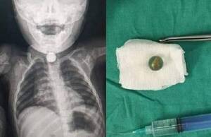 Crónica / ¡Niño de 2 años se atragantó con balita!
