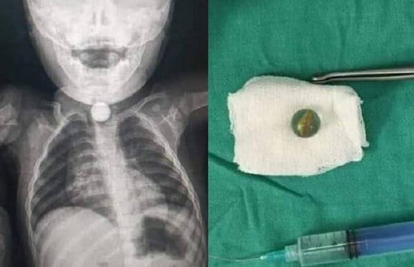 Crónica / ¡Niño de 2 años se atragantó con balita!