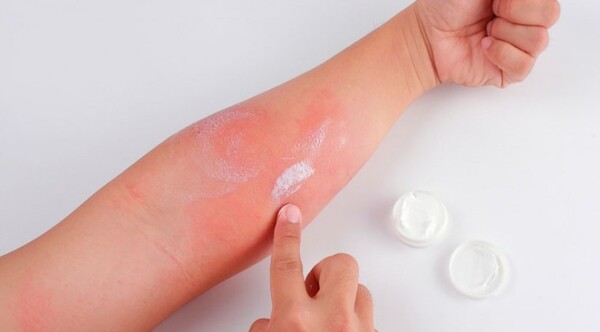 Diario HOY | Dermatitis atópica: casos pueden ir de cuadros leves a recalcitrantes
