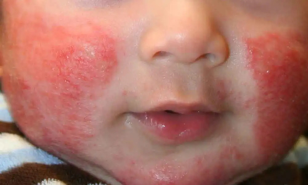 Dermatitis atópica: Casos pueden ir de cuadros leves a recalcitrantes - OviedoPress