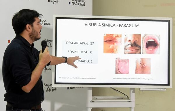 Viruela del Mono: “Las bombas caen muy cerca y llama la atención de que no tengamos ningún otro caso”, afirman - A La Gran 7-30 - ABC Color