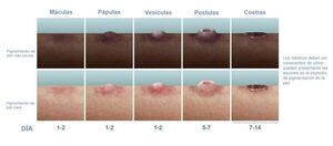Viruela del mono: Ministerio de Salud pide “sincerar” y no “minimizar” aparición de lesiones - Nacionales - ABC Color