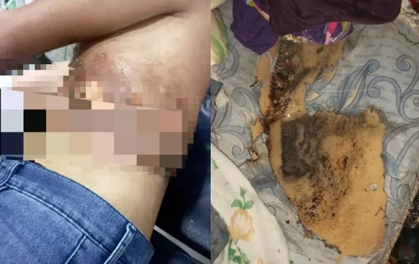 Rayo cayó sobre celular enchufado y ocasionó graves quemaduras a un joven - Noticiero Paraguay