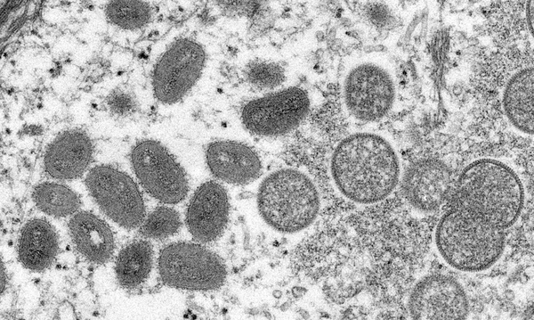 En el Estado de Paraná confirman 24 nuevos casos de viruela del mono - La Clave