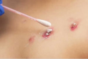 Sin reporte de casos de viruela símica y con marcado descenso del coronavirus en Paraguay