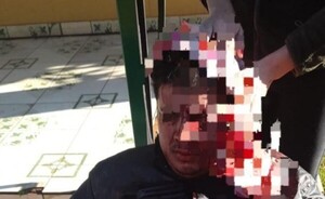 Motociclista quedó sin frenos y sufrió severa herida