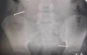 Por culpa de Tik Tok una niña de 10 años tragó 3 clavos