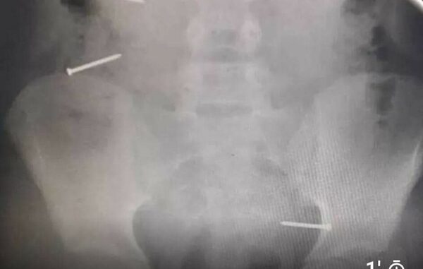 Por culpa de Tik Tok una niña de 10 años tragó 3 clavos