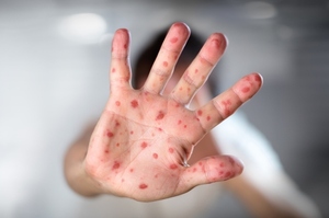 Salud confirma segundo caso de viruela símica en Paraguay | Lambaré Informativo