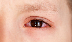 Menor de 5 años tenía una piedrita en el ojo