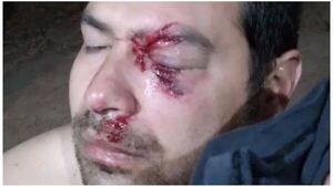 Jóvenes golpean a bombero voluntario y casi pierde la vista