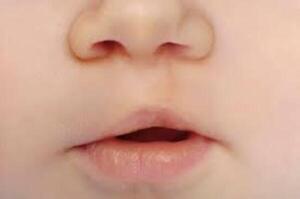Diario HOY | Convocan a niños con labio leporino para cirugías reconstructivas