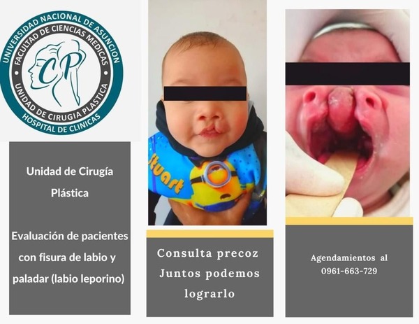 Ofrecen cirugías gratuitas para niños con labio y paladar hendido en Clínicas | 1000 Noticias