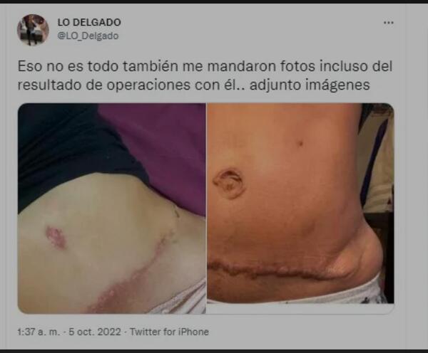 Diario HOY | Superintendencia de Salud investiga a cirujano plástico con más de 60 denuncias por mala praxis