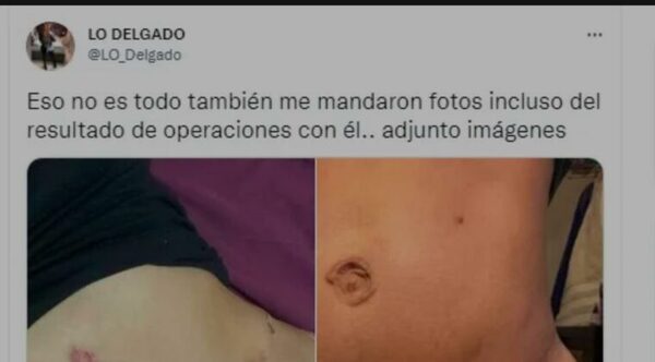Superintendencia de Salud investiga a cirujano plástico con más de 60 denuncias por mala praxis