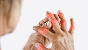 Artritis reumatoidea: ¿tiene cura y cómo puedo tratarla?