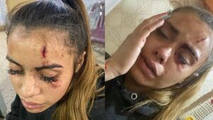 Bailarina denunció que su hermano la golpeó brutalmente